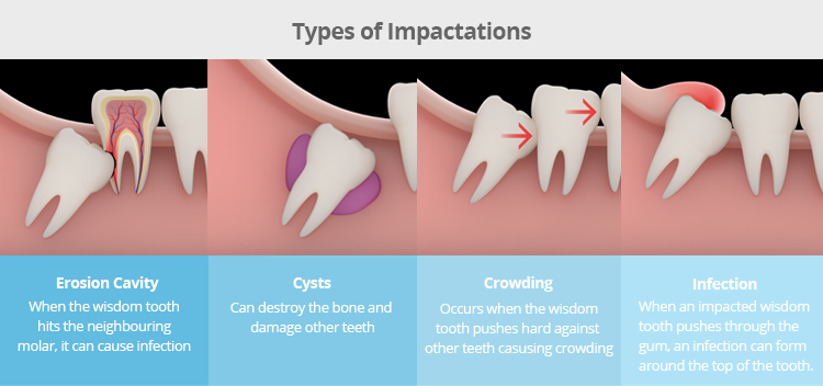 types wisdom teeth removal