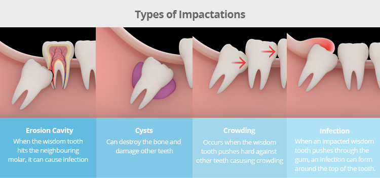 wisdom teeth recovery tips salt water